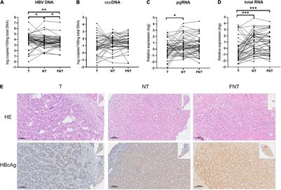 Hepatitis B Virus Pregenomic RNA Reflecting Viral Replication in Distal Non-tumor Tissues as a Determinant of the Stemness and Recurrence of Hepatocellular Carcinoma